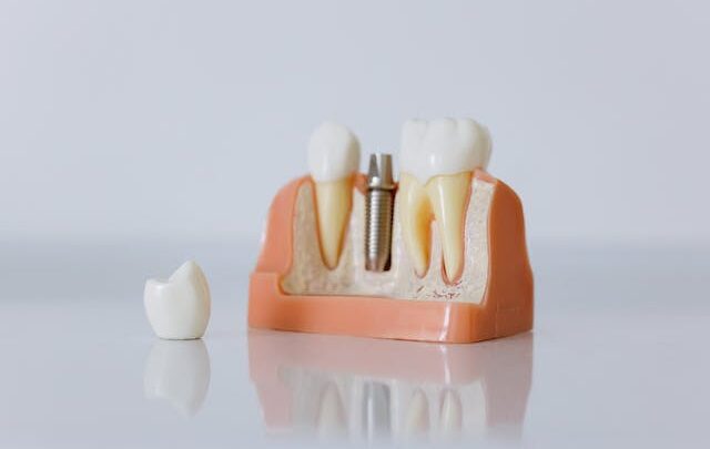 Budowa implantów zębowych