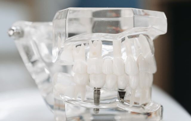 Kiedy warto zdecydować się na implant zęba?