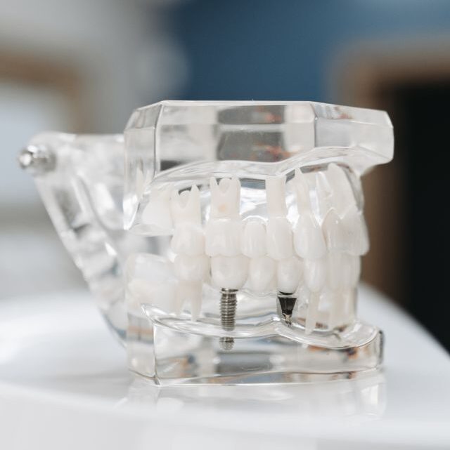 Kiedy warto zdecydować się na implant zęba?